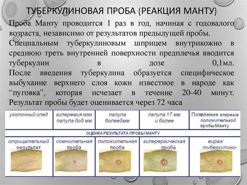 Норма реакции манту у детей 1 года