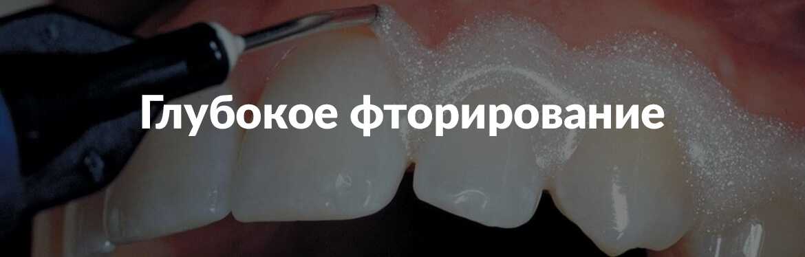 Фторирование эмали зубов в клинике