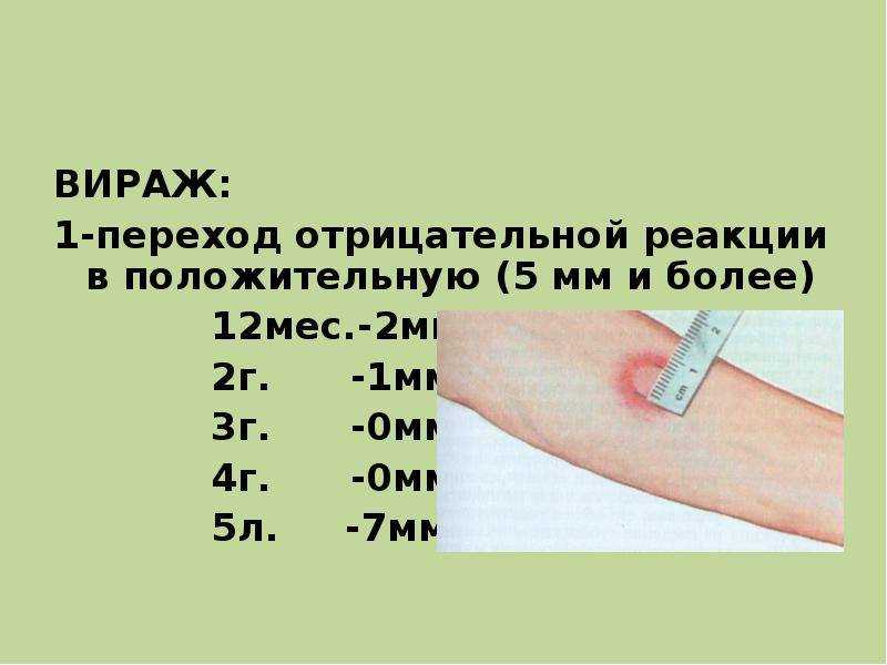 Вираж пробы манту у ребенка: что это такое и что делать