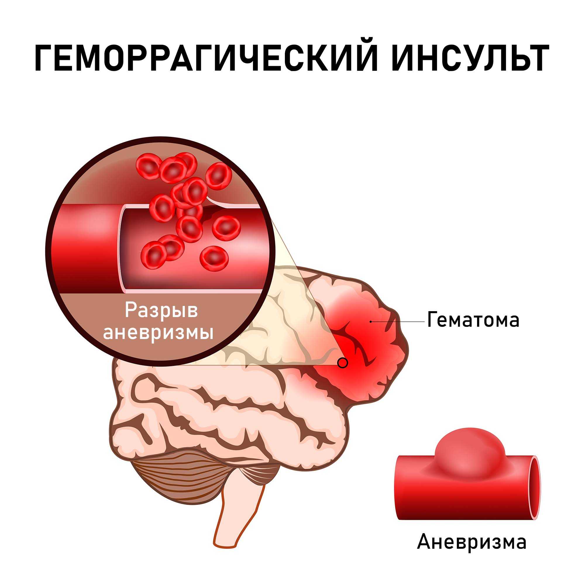 Геморрагический инсульт: последствия, лечение, симптомы, прогноз