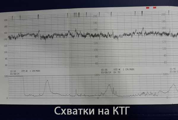 Кардиотокография (ктг) при беременности: зачем и что покажет