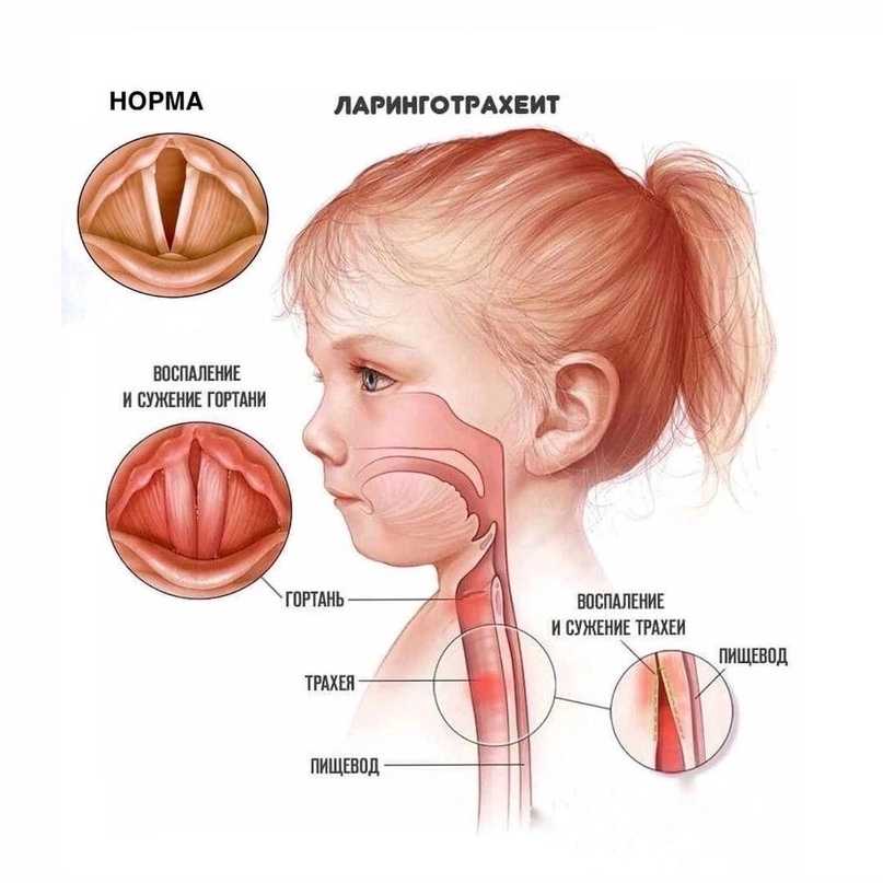 Ларинготрахеит: симптомы, диагностика, лечение
