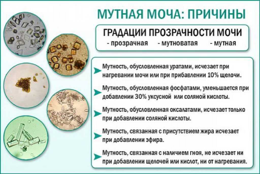 Белые хлопья в моче у ребенка  Белые хлопья в моче у ребенка  Любые примеси в моче, выявленные родителям, могут быть как признаком болезни, так и безобидным