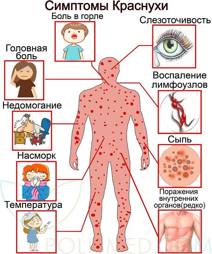 Симптомы и лечение коревой краснухи у детей: как выглядит сыпь, фото и профилактика болезни