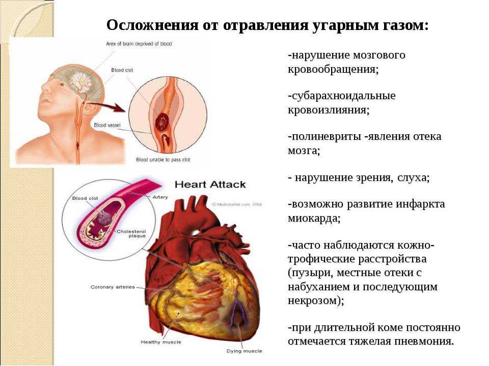 Отравление бытовым газом: симптомы, возможные последствия, первая медицинская помощь и лечение