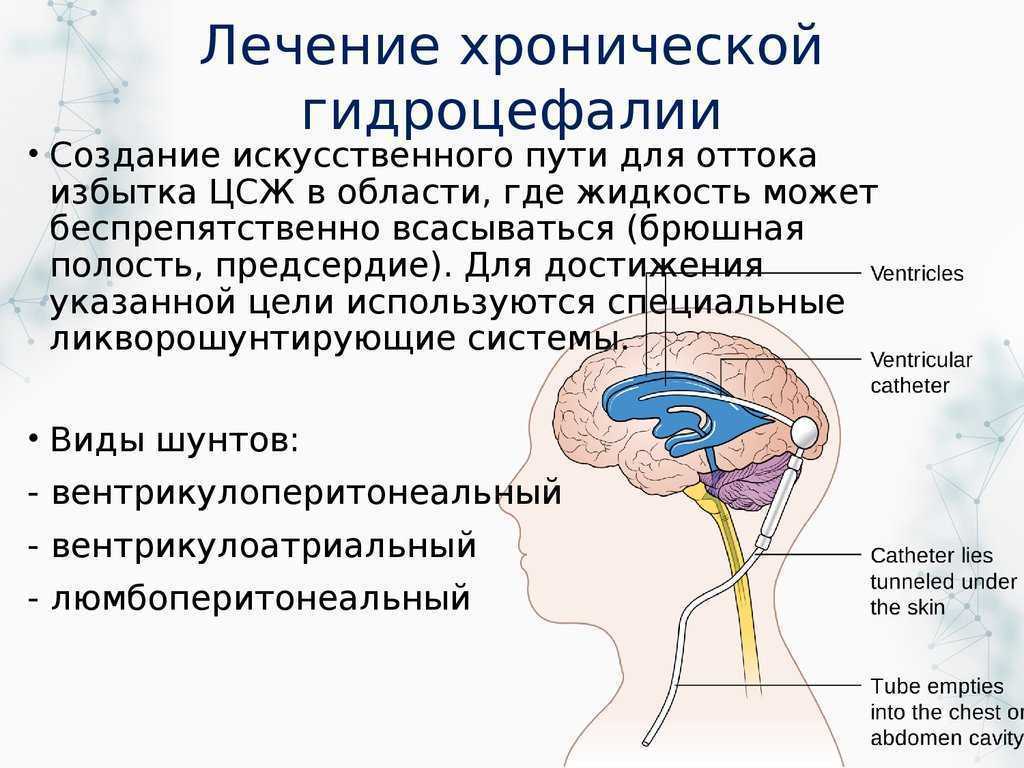Гидроцефалия (водянка головного мозга) – что это такое, причины, признаки и симптомы гидроцефалии у взрослого и у ребёнка, диагностика и лечение