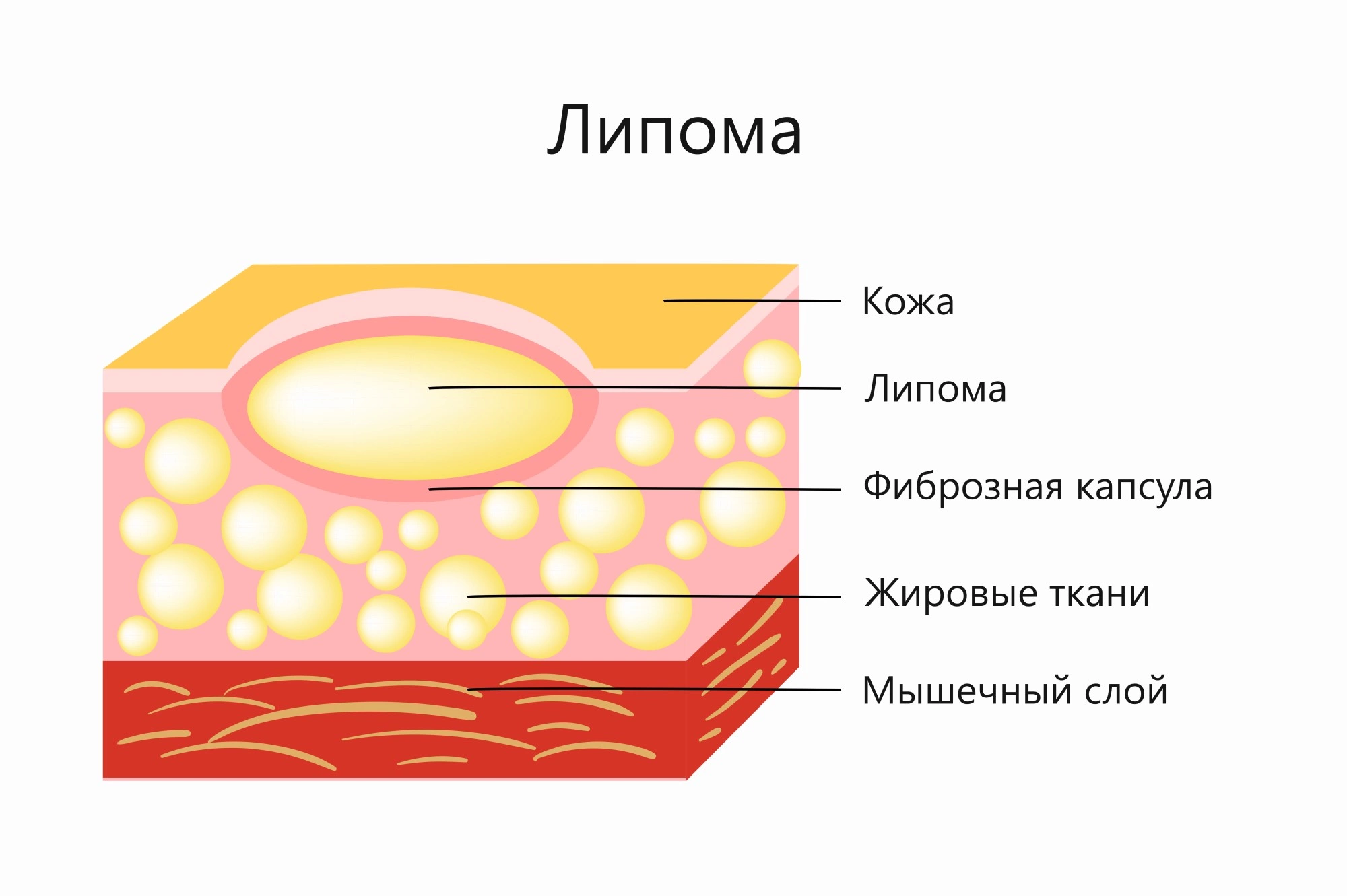 В чём разница атеромы и липомы?