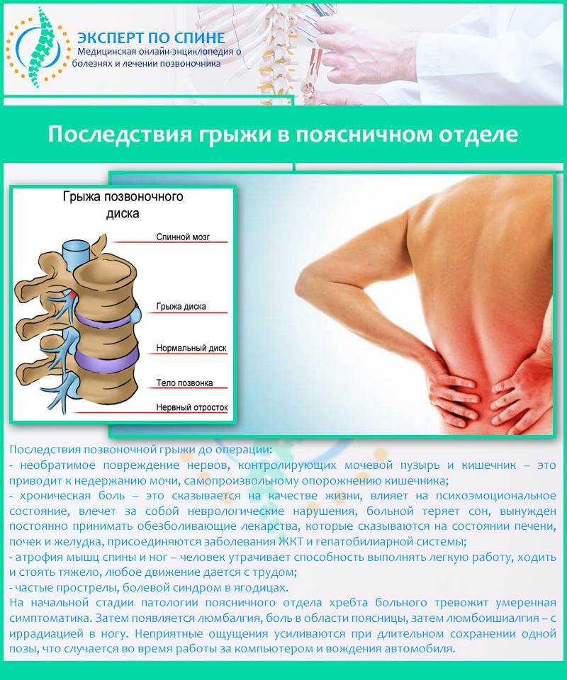 Можно ли получить инвалидность при грыже позвоночника?