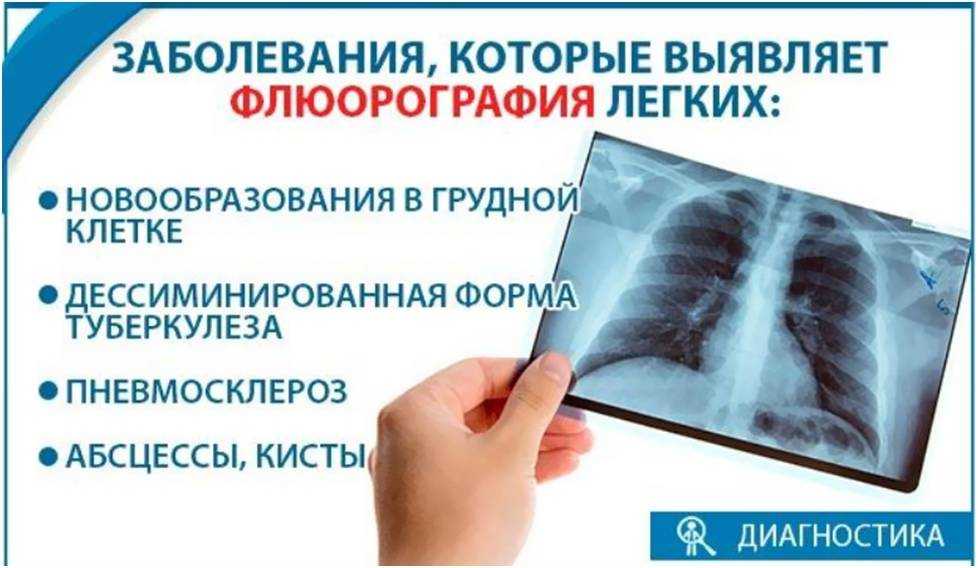 Флюорография на ранних сроках беременности, можно ли делать флюорографию беременной
