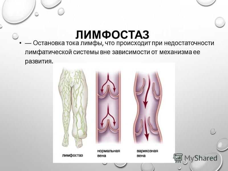 Лимфостаз нижних конечностей: роль лимфодренажа при лечении недуга