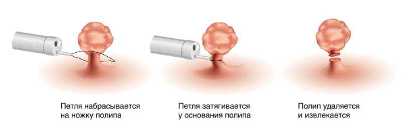 Удаление полипов в носу лазером