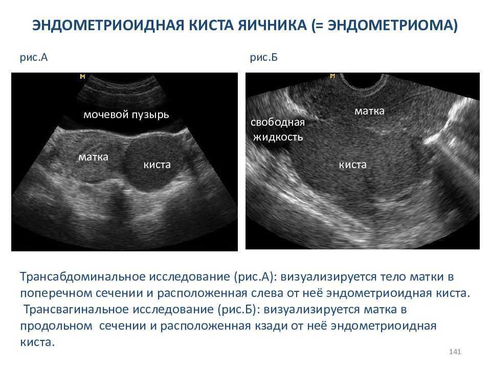 Кистозное образование левого яичника