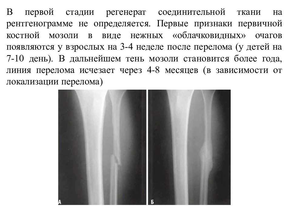 Костная мозоль после перелома: виды, причины, симптомы образования, особенности лечения