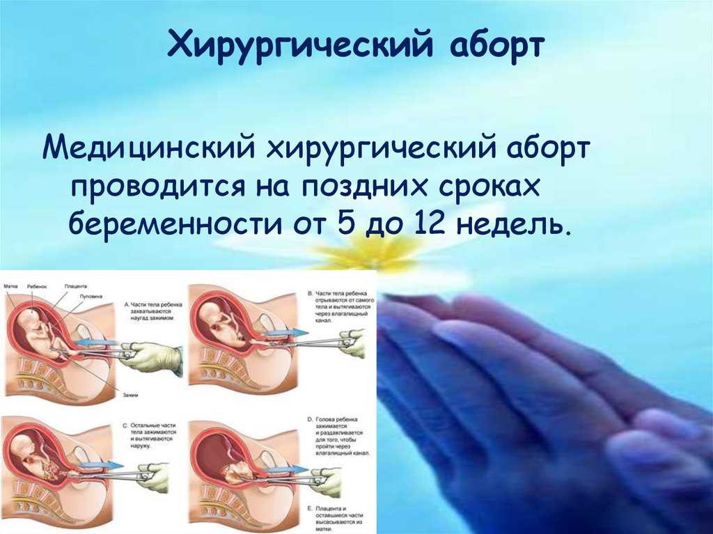 Последствия аборта: осложнения, беременность после аборта