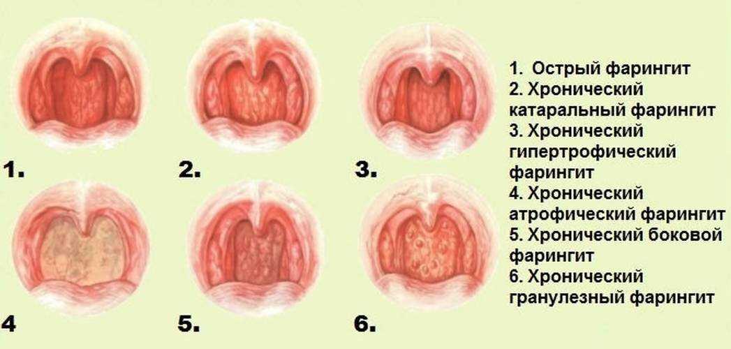 Лептотрикс в мазке: что это такое, лечение в гинекологии