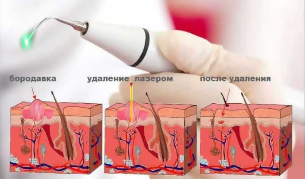 Могут ли папилломы исчезнуть сами на интимных местах после лечения