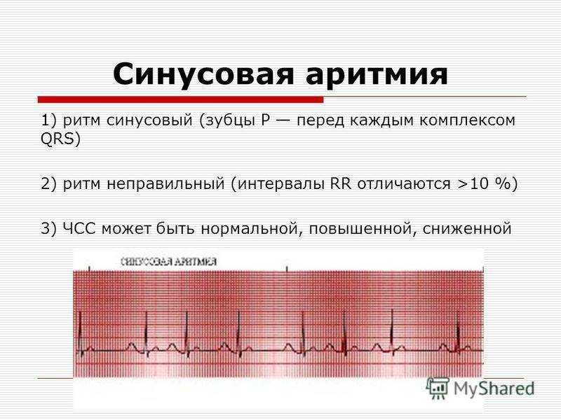 Аритмия у детей: причины патологии сердца, симптомы, лечение