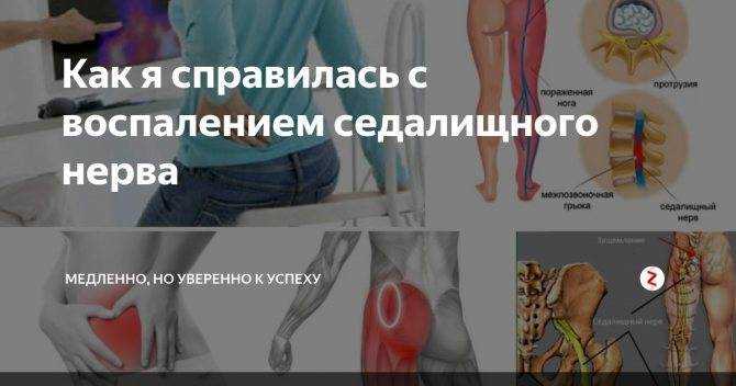 Уколы при защемлении седалищного нерва: препараты разных групп
