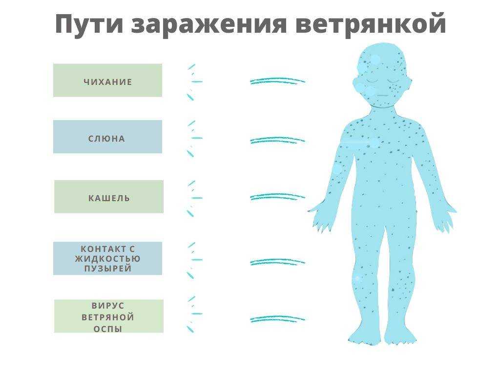 Ветрянка (ветряная оспа) у взрослых: симптомы и лечение, инкубационный период, как передается и как начинается болезнь