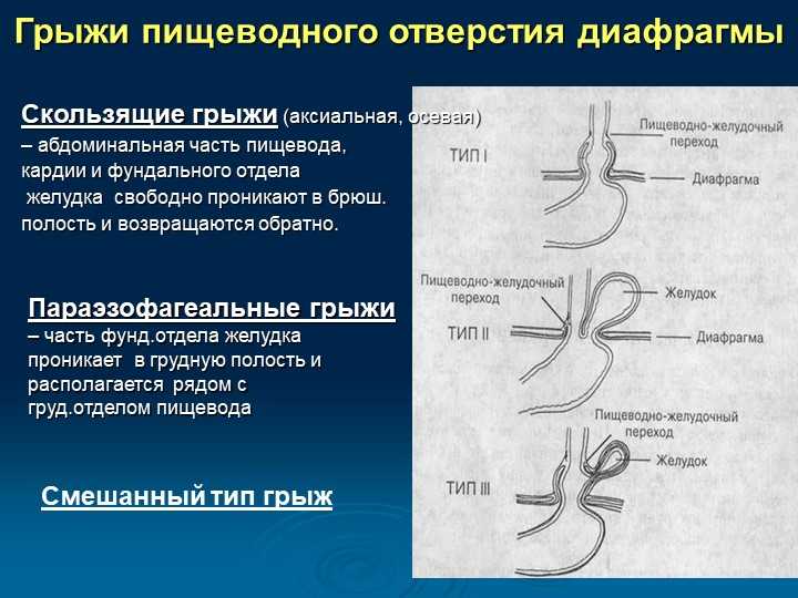 Грыжа пищеводного отверстия диафрагмы - гпод симптомы и лечение