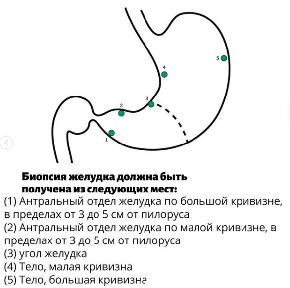 Расшифровка биопсии желудка рак