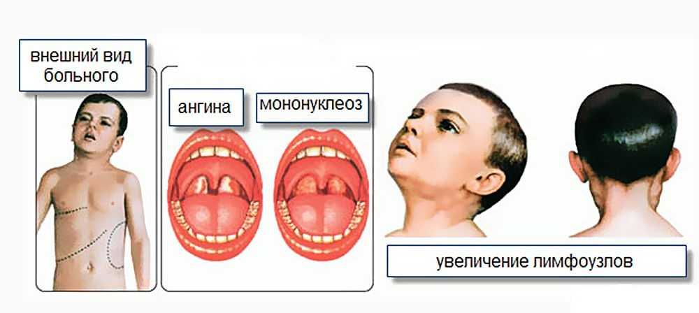 10 фактов о мононуклеозе   | материнство - беременность, роды, питание, воспитание