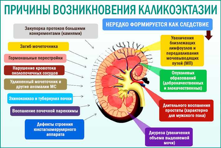 Причины развития, симптоматика и принципы лечения каликопиелоэктазии почек  Причины развития, симптоматика и принципы лечения каликопиелоэктазии почек