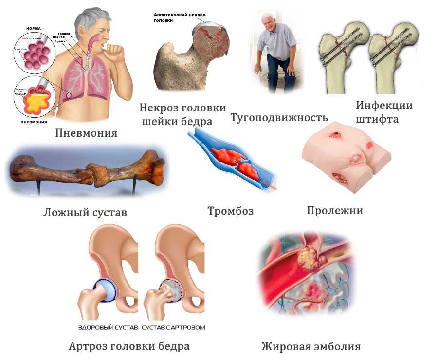 Через неделю после перелома поднялась температура