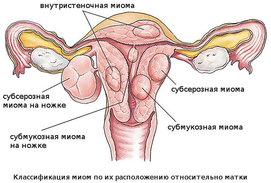 Интрамуральный узел - что это такое, субзерозная миома матки на задней стенке
