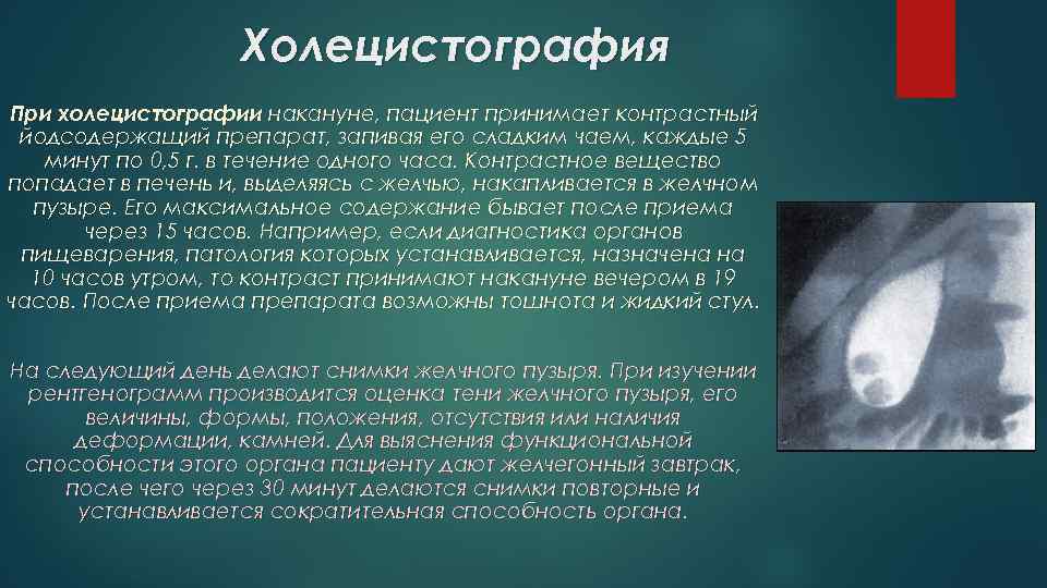 Холецистография с контрастированием при диагностике желчного пузыря | nowfoods-ru.ru