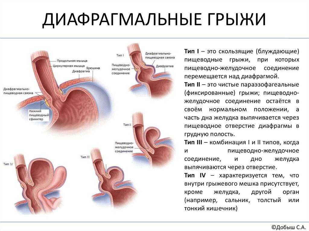 Скользящая грыжа пищеводного отверстия диафрагмы: лечение заболевания