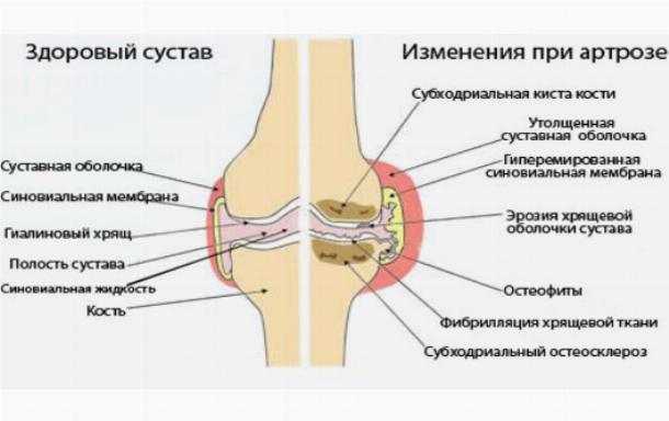 Коксартроз тазобедренного сустава