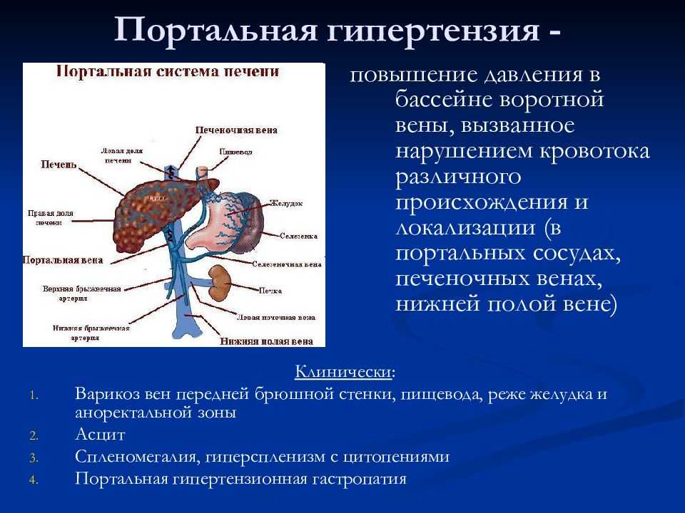 Билиарная гипертензия печени что это такое