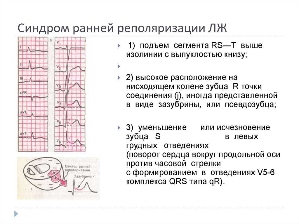 Синдром ранней реполяризации желудочков у детей — что это значит?