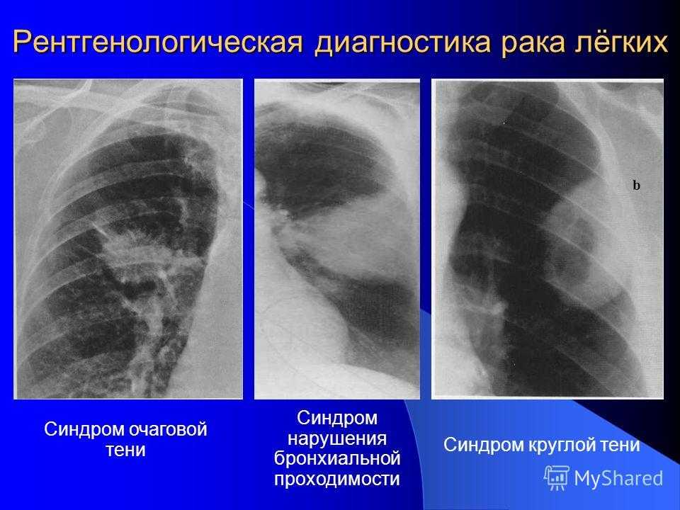 Затемнение в легких на мрт  что значит темное пятно на снимке мрт легких