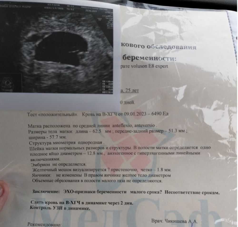 Анэмбриония - причины, симптомы, диагностика, лечение и профилактика