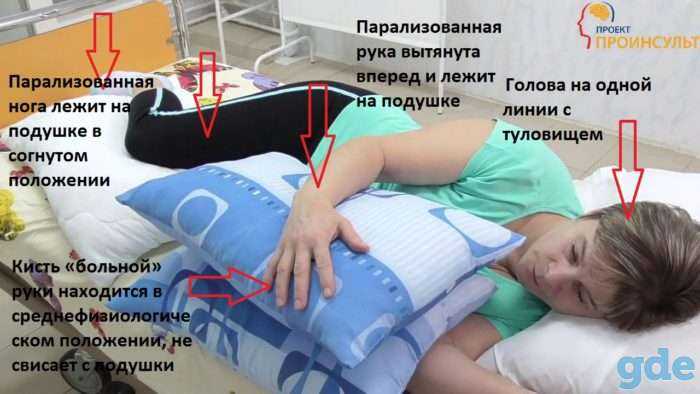 Если развилась кома после инсульта, что ждать родным больного