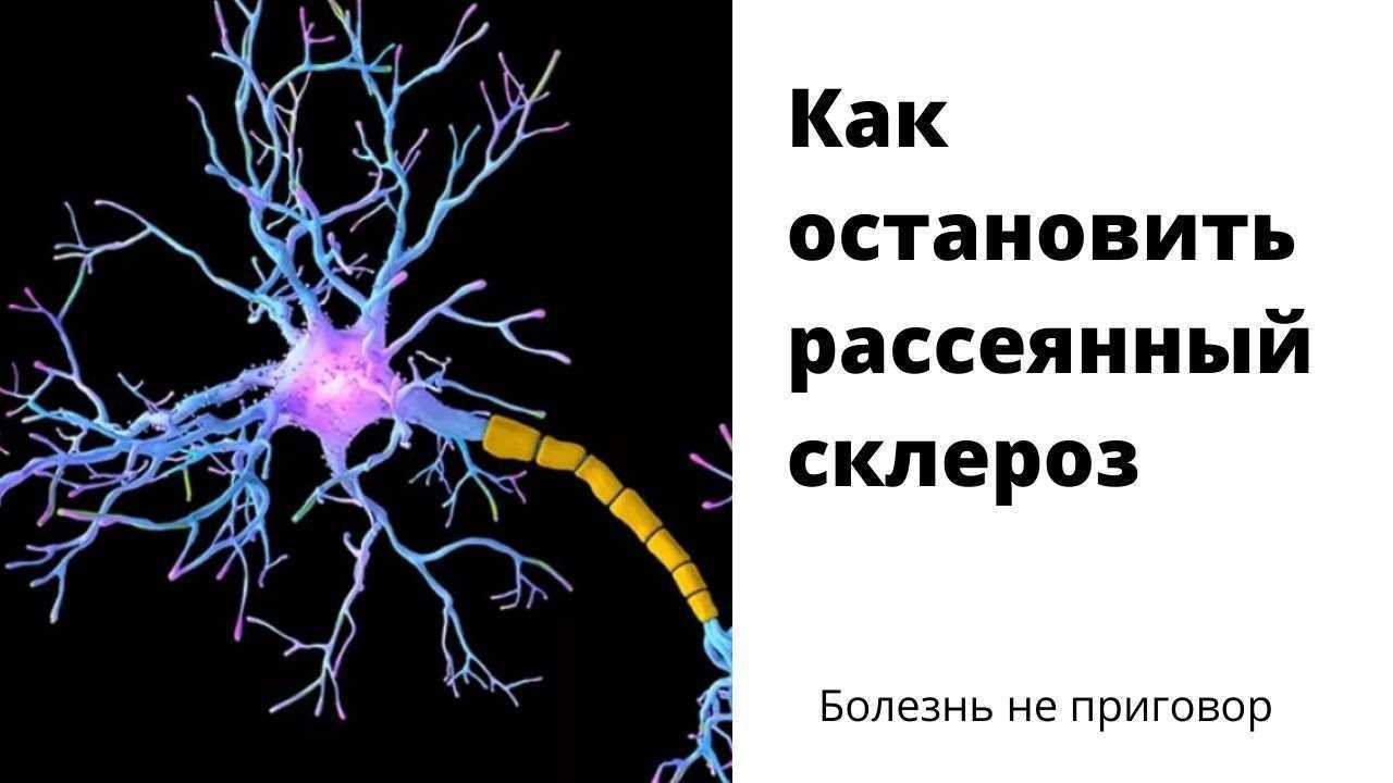 Сколько живут с рассеянным склерозом: примерные сроки | mnogoli.ru