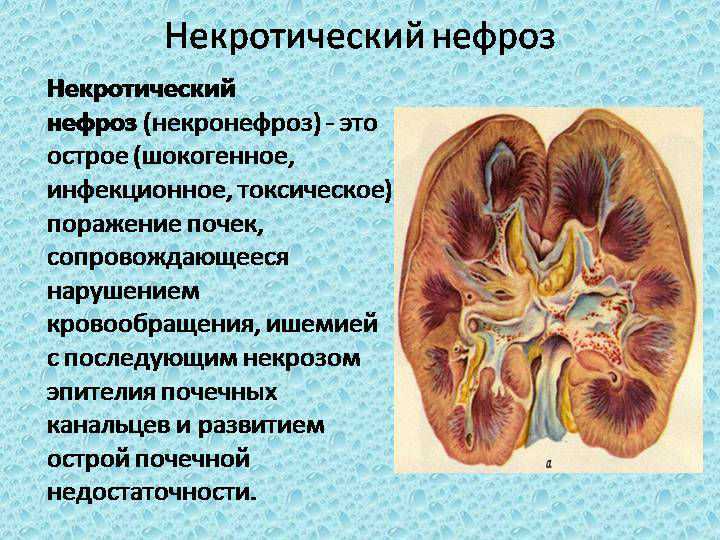 Симптомы почечной интоксикации: как распознать и преодолеть
