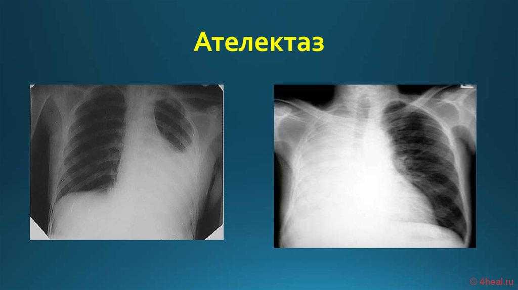 Ателектаз легкого - что это такое, причины, лечение, симптомы
