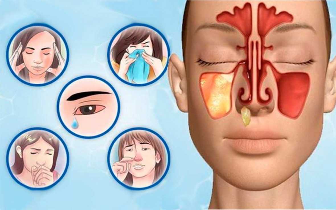 Первые признаки гайморита: симптомы и лечение