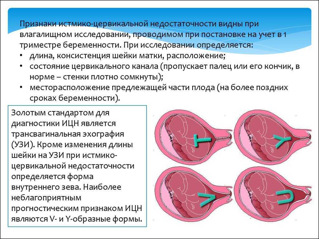 Цервикометрия при беременности - что это, норма длины цервикального канала, тактика лечения при укороченной и незрелой шейке матки