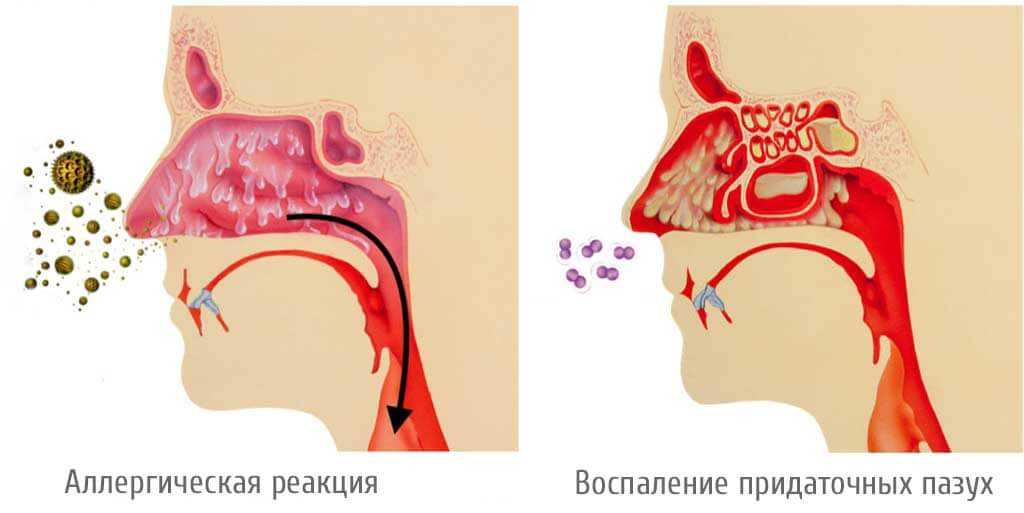 Заразна ли простуда от переохлаждения