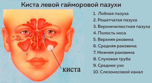 Киста верхнечелюстной пазухи: симптомы, причины и методы лечения