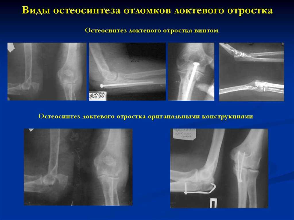 Преимущества остеосинтеза при лечении перелома локтевой кости