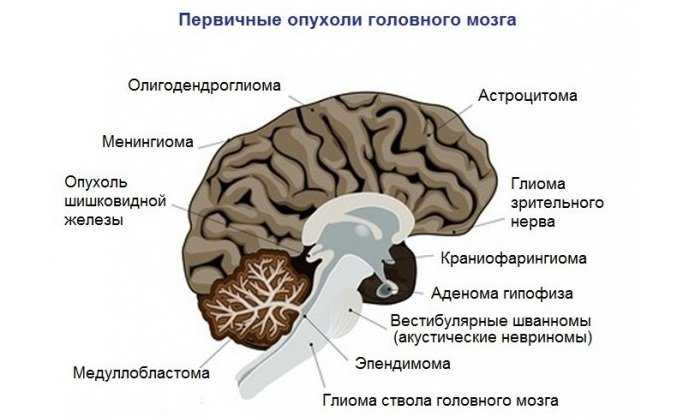 Опухоль головного мозга: симптомы и признаки на ранних стадиях, причины и лечение