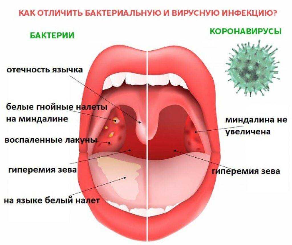 Красное горло длительное время: лечение, народные способы