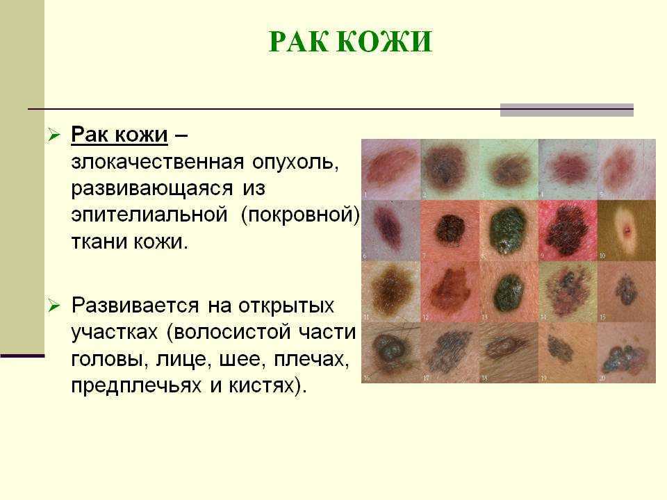 Бородавки – происхождение и лечение