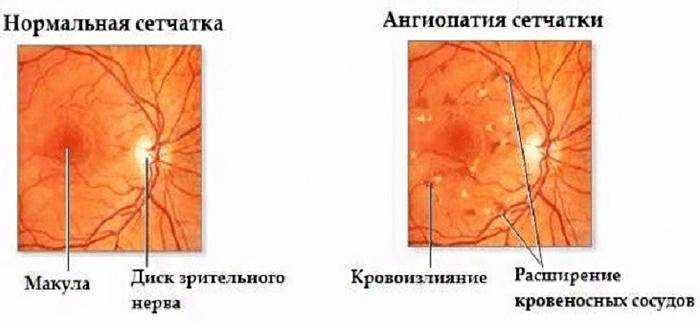 Ангиопатии нижних конечностей