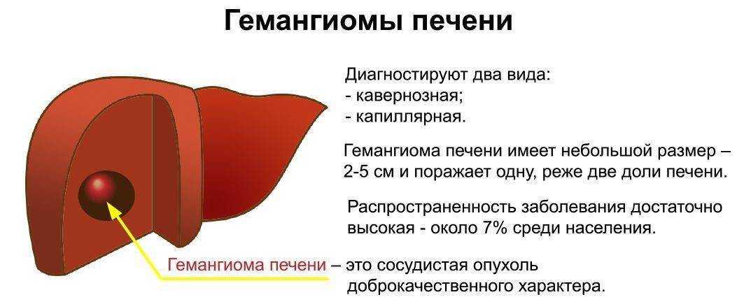 Гемангиома: что это, фото и симптомы, причины, лечение и виды сосудистых опухолей